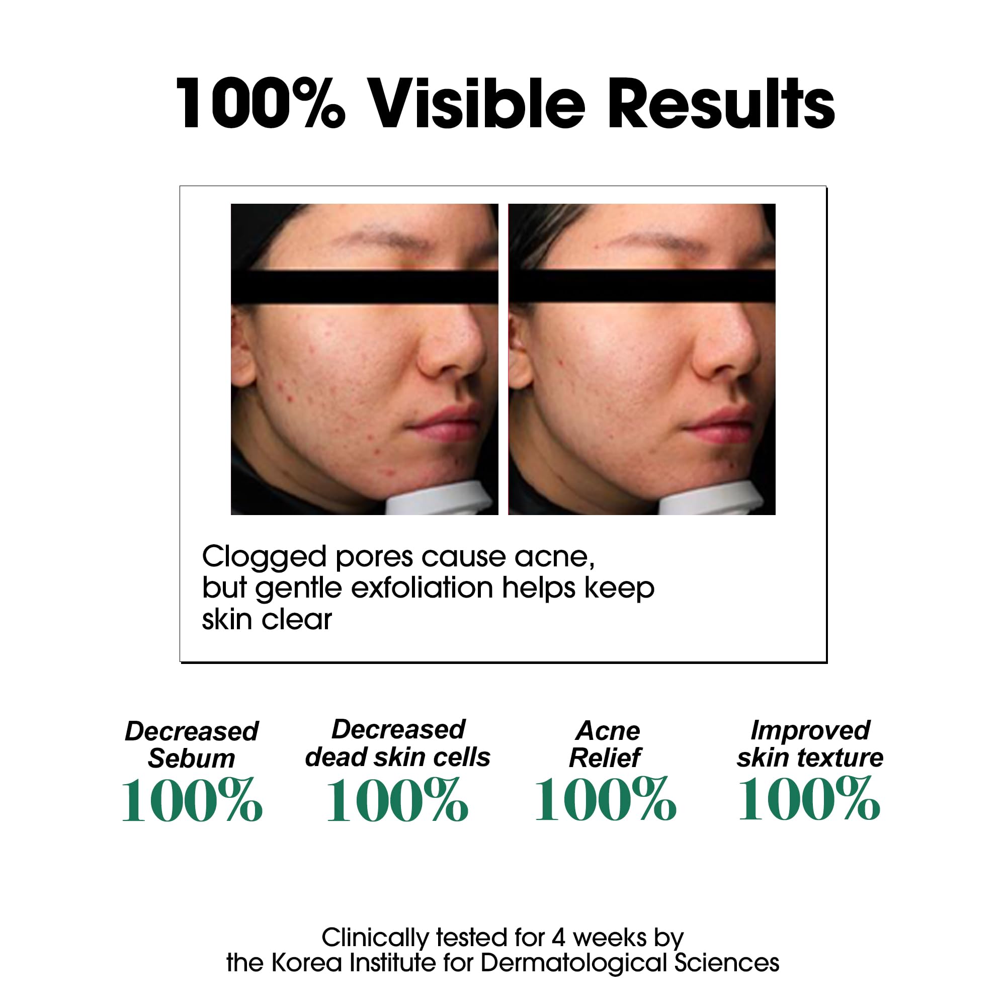 SOME BY MI AHA BHA PHA 30 Days Miracle Toner – 5.07oz, 150ml – Korean Salicylic Acid Exfoliating Face Toner for All Skin Types – Daily Pore Care & Oil Control with 2% Niacinamide – Korean Skin Care